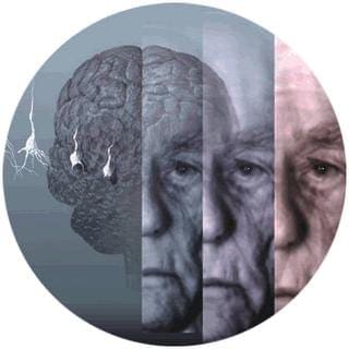 Detectan el Alzheimer 20 años antes de primeros síntomas